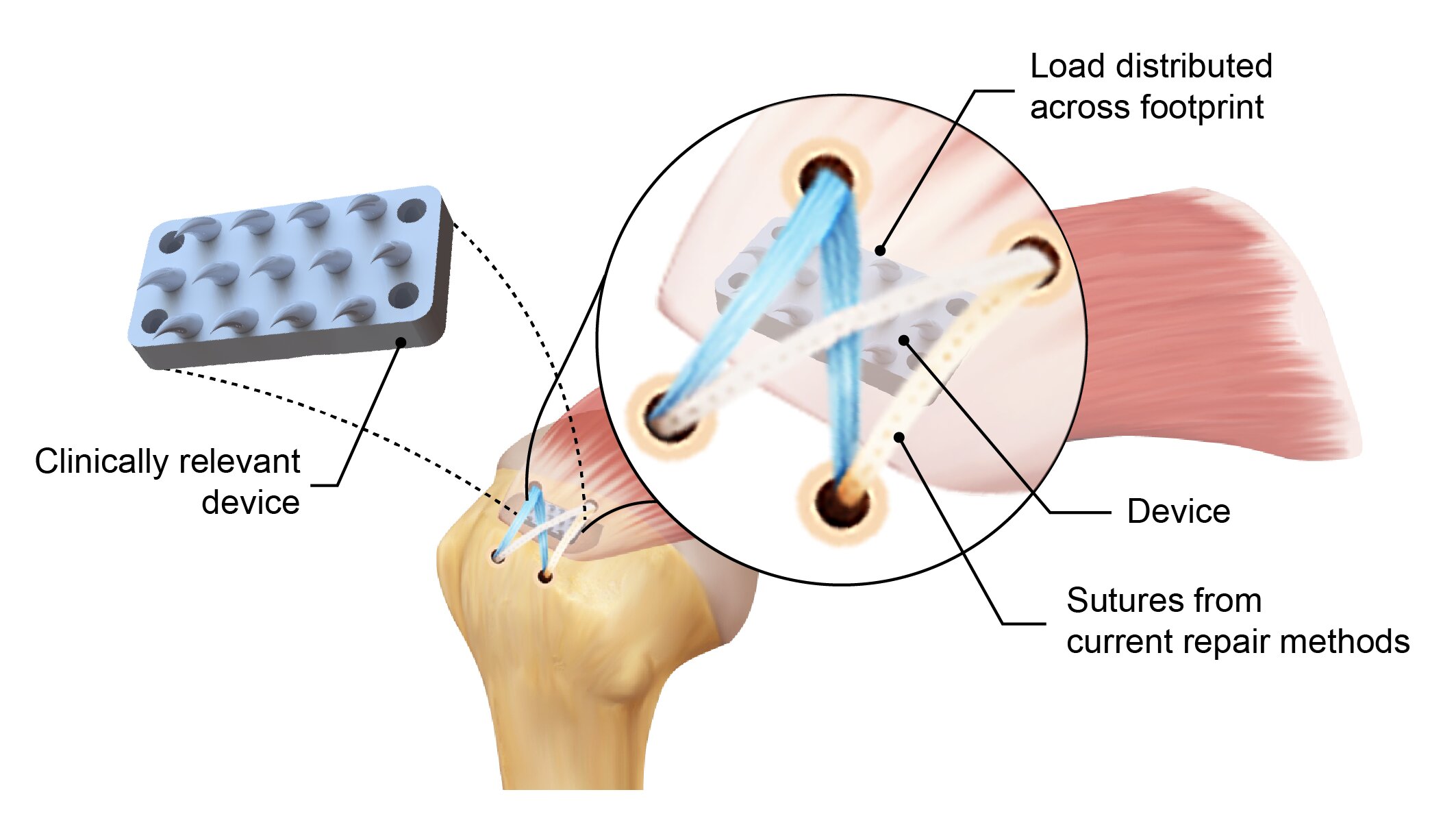 Read more about the article A new device inspired by python teeth may reduce the risk of rotator cuff tears