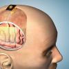 This illustration demonstrates how the thin film of sensors can be applied to the brain during surgery.